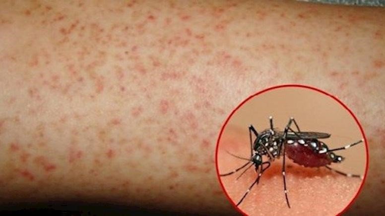 TP.HCM: Hai huyện có số ca bệnh sốt xuất huyết tăng báo động