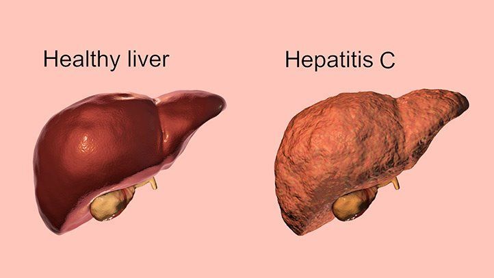 Những điều cần biết về tải lượng virus viêm gan C